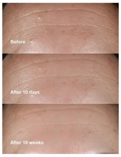 Clinique Smart Clinical Repair Wrinkle Correcting Serum 1% Retinoid